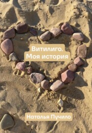 Витилиго. Моя история