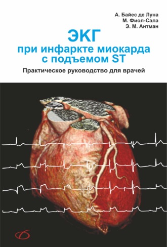 ЭКГ при инфаркте миокарда с подъемом ST